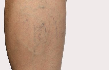  telangiectasia and spider veins on the leg clipart