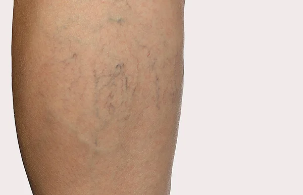 Telangiectasia and spider veins on the leg — Stock Photo, Image