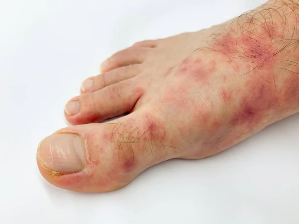 白い背景に赤い発疹の病気と男性の足とつま先のアップを閉じます ストック画像 ストック写真