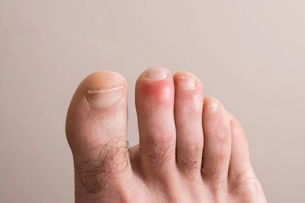 Detail Foot Chilblains His Fingers Illness Caused Cold — Stock Photo, Image