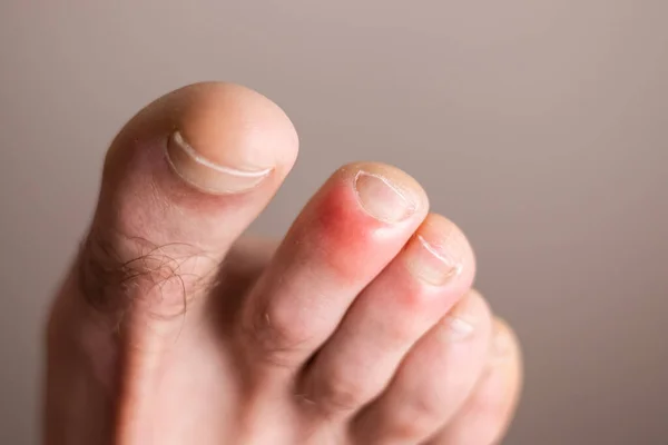 Parmaklarında Titreme Olan Ayak Izleri Soğuktan Kaynaklanan Bir Hastalık — Stok fotoğraf