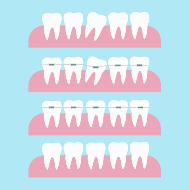 Ortodontik diş telleriyle yapılan diş düzeltmeleri. Diş ortodontik tedavi vektör çizimi. Diş teli düzeltme kavramından önce ve sonra