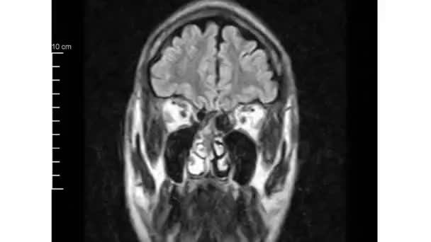 Twee Weergaven Schedel Magnetische Resonantie — Stockvideo