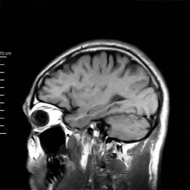 Kafatasının nükleer manyetik rezonans görüntüsü