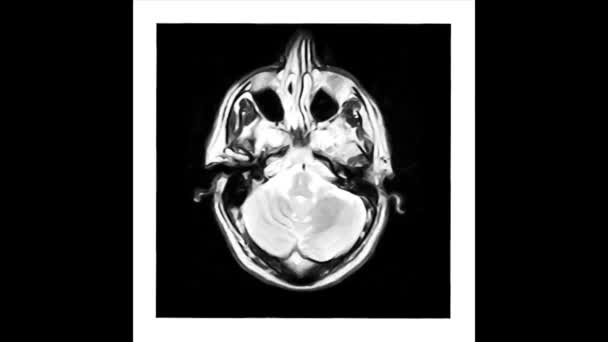 Магнитно Резонансная Томография Вида Черепа Сверху — стоковое видео