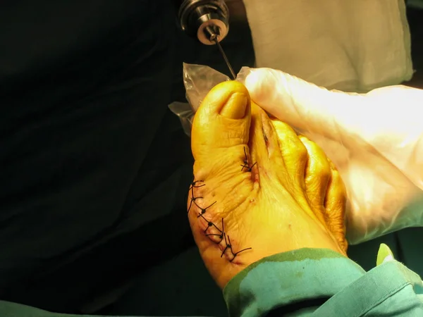 Hallux Valgus Foot Surgery Operating Room — Stock Photo, Image