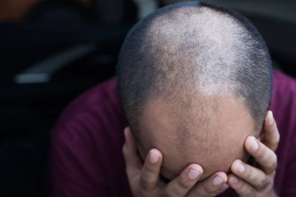 Close Man Head Hair Loss — Stock Photo, Image