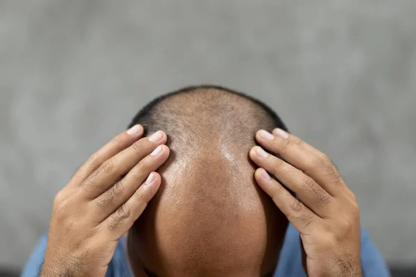 Cerca Hombre Cabeza Pérdida Cabello —  Fotos de Stock