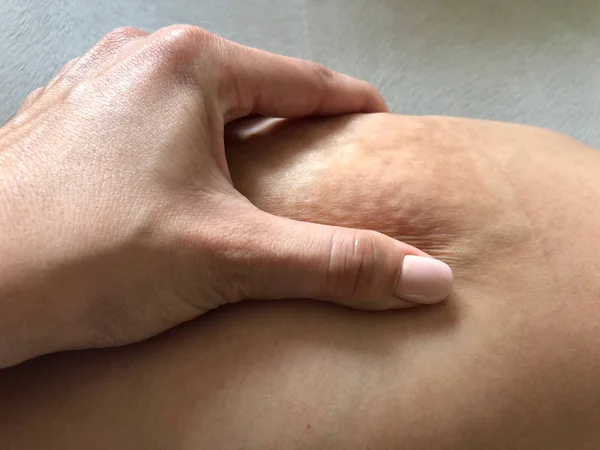 Meisje knijpt een cellulitis op haar been — Stockfoto