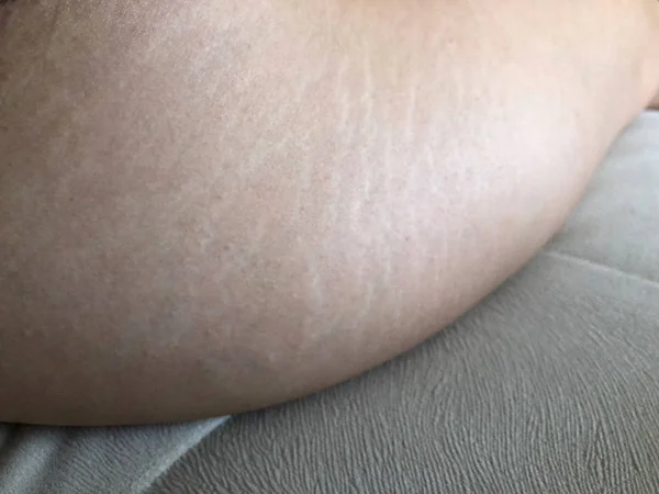 Vrouw is het testen van de huid op de dij voor de aanwezigheid van cellulitis — Stockfoto