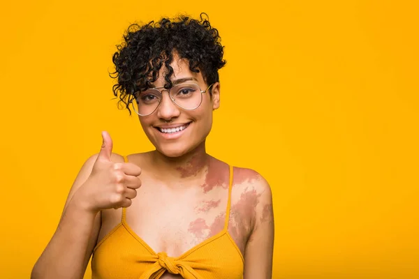 Young african american woman with skin birth mark smiling and raising thumb up