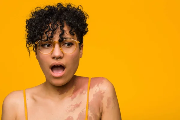 Mujer Afroamericana Joven Con Marca Nacimiento Piel Siendo Sorprendido Por —  Fotos de Stock