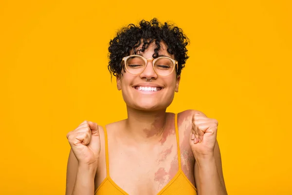 Mujer Afroamericana Joven Con Marca Nacimiento Piel Levantando Puño Sintiéndose —  Fotos de Stock