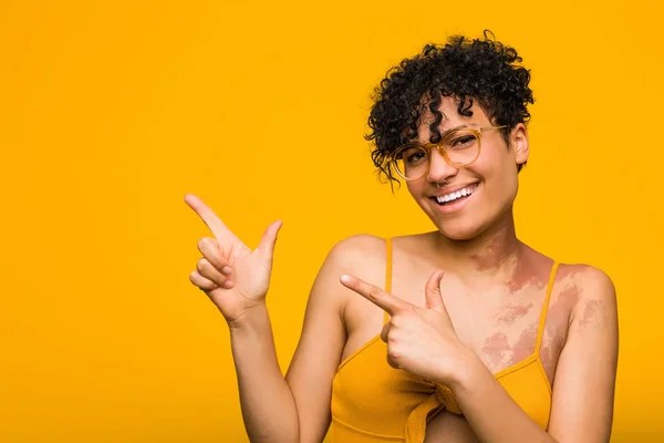Young african american woman with skin birth mark pointing with forefingers to a copy space, expressing excitement and desire.