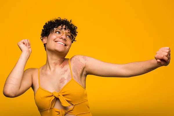 Joven Mujer Afroamericana Con Marca Nacimiento Piel Bailando Divirtiéndose —  Fotos de Stock