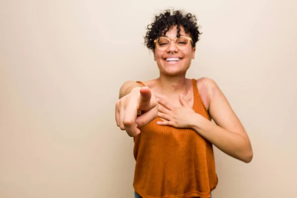 Młody African American Kobieta Punktami Urodzenia Skóry Palca Kciuka Śmiech — Zdjęcie stockowe
