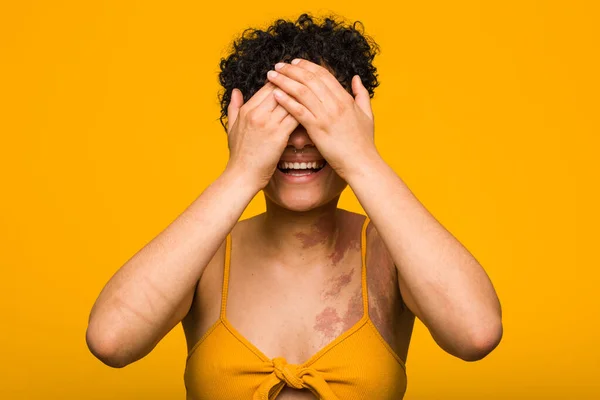 Mujer Afroamericana Joven Con Marca Nacimiento Piel Cubre Los Ojos — Foto de Stock