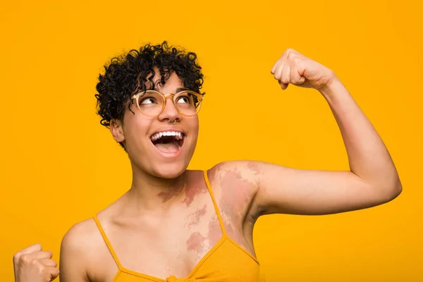 Young african american woman with skin birth mark raising fist after a victory, winner concept.