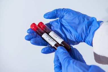 Doktor Coronavirus virüsü bulaşmış, maske ve eldiven takmış pozitif ve negatif kan örneği tutuyor. Salgın COVID-19
