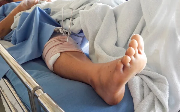 foot splint with iron on leg