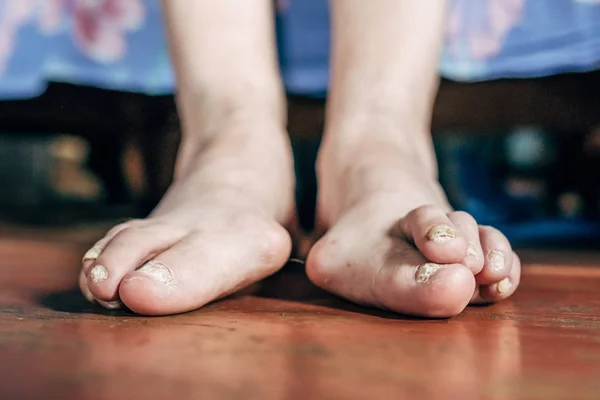 Barefoot Which Have Bunion Hallux Valgus Problem Wooden Brown Floor — Stock Photo, Image