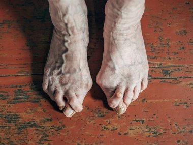 Çıplak ayakla olan şişik (Halluks valgus) ahşap kahverengi zemin üzerinde sorun. Deformasyon için ayak başparmağı bağlayan eklem