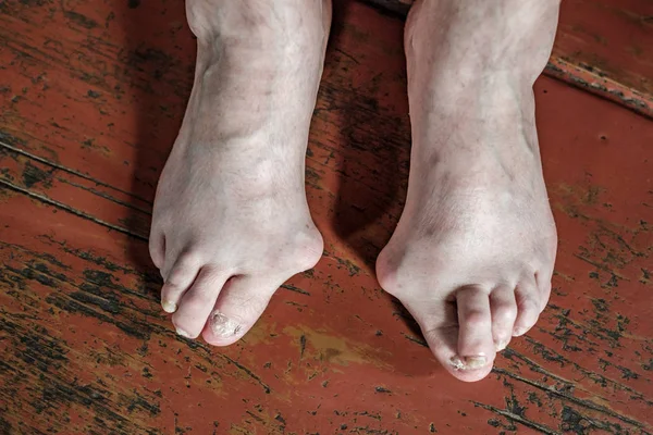 裸足では茶色のフローリングに腱膜瘤 外反母趾 問題を抱えています 足に足の親指を接続する継手の変形 — ストック写真