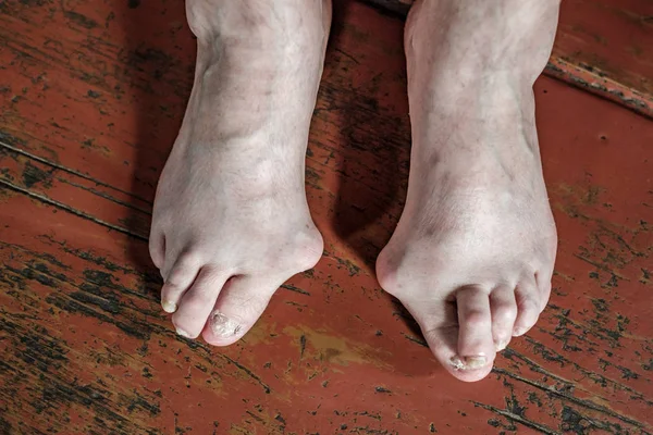 Барофуты Которые Имеют Проблему Bunion Hallux Valgus Деревянном Коричневом Полу — стоковое фото