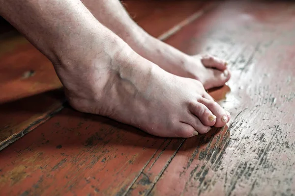 Barefoot Which Have Bunion Hallux Valgus Problem Wooden Brown Floor — Stock Photo, Image