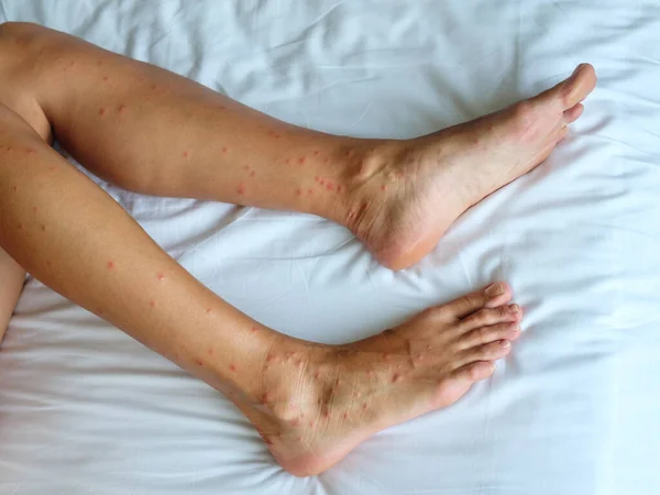 Θηλυκά Πόδια Πολλά Κόκκινα Σημάδια Και Ουλή Από Τσιμπήματα Μύγας — Φωτογραφία Αρχείου