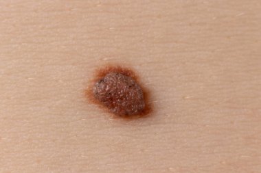İnsan derisindeki köstebek doğum lekesi Nevus makro fotoğrafı. Kapat..