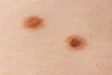 İnsan derisinde iki köstebek doğum lekesi Nevus makro fotoğrafı. Kapat..