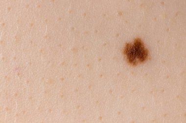 İnsan derisindeki köstebek doğum lekesi Nevus makro fotoğrafı. Kapat..