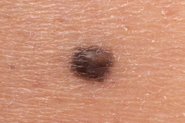 Mole birthmark nevus macro photo on human skin. Close up. clipart