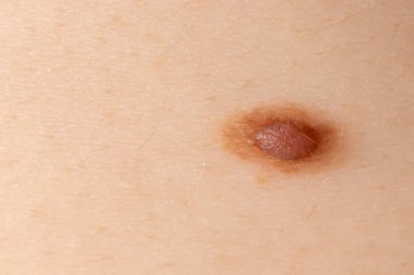 İnsan derisindeki köstebek doğum lekesi Nevus makro fotoğrafı. Kapat..