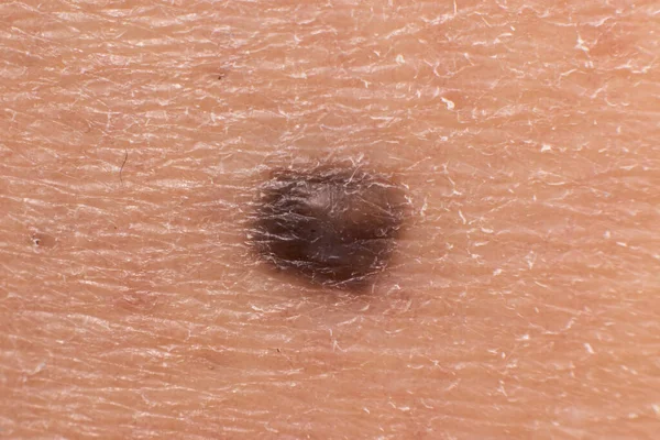 Lunar marca de nacimiento nevus macro foto en la piel humana. De cerca.. — Foto de Stock