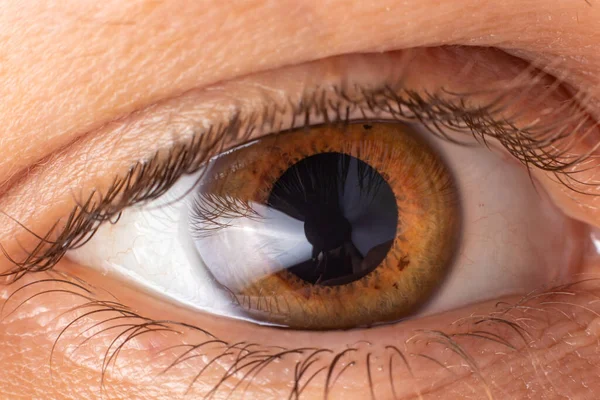 Photo macro-oculaire. Kératocône - maladie oculaire, amincissement de la cornée sous la forme d'un cône. Le plastique de la cornée — Photo
