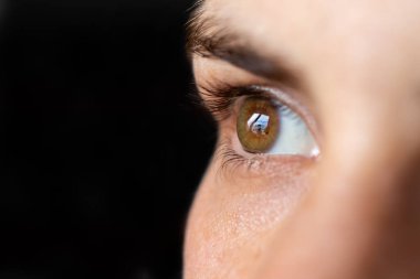 Makro göz fotoğrafı. Keratoconus 3 derece - göz hastalığı, koni şeklinde kornea incelmesi. Kornea plastiği.