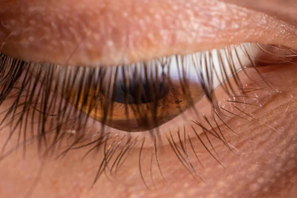 Foto de ojo macro. Queratocono 3 grado enfermedad ocular, adelgazamiento de la córnea en forma de cono. El plástico de la córnea —  Fotos de Stock