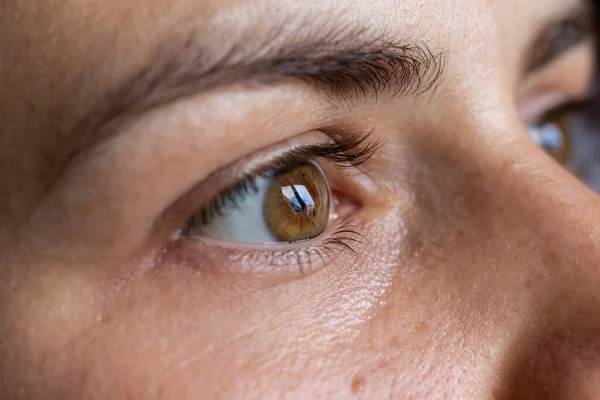 Queratocono de ambos ojos, 2º y 4º grado. Contorsión de la córnea en forma de cono, deterioro de la visión, astigmatismo —  Fotos de Stock