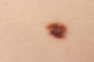 İnsan derisindeki köstebek doğum lekesi Nevus makro fotoğrafı. Kapat..
