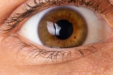 Makro göz fotoğrafı. Keratoconus - göz hastalığı, koni şeklinde korneanın seyrelmesi. Kornea plastiği.
