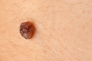 İnsan derisindeki köstebek doğum lekesi Nevus makro fotoğrafı. Kapat..