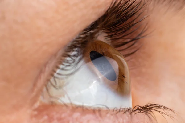 Keratoconus van het oog, 4e graad. Contortie van het hoornvlies in de vorm van een kegel, verslechtering van het gezichtsvermogen, astigmatisme. Macro close-up — Stockfoto