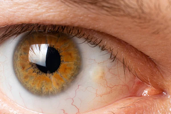 Pinguecula глаза макро фото крупным планом мужского глаза. Желтое образование на шкуре, глаза фермеров — стоковое фото