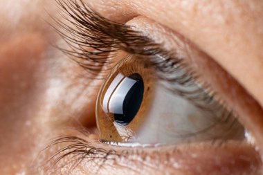 Keratoconus göz, 3 derece. Korneanın koni şeklinde bükülmesi, görme bozukluğu, astigmatizm. Makro, kapat.