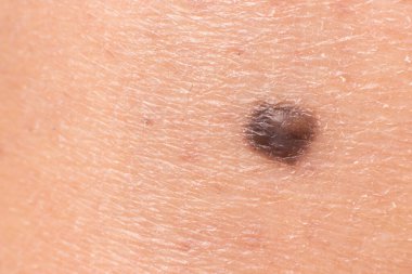 İnsan derisindeki köstebek doğum lekesi Nevus makro fotoğrafı. Kapat..
