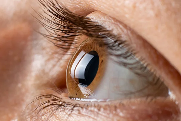 Cheratocono oculare, terzo grado. Contorsione della cornea sotto forma di cono, deterioramento della vista, astigmatismo. Macro da vicino — Foto Stock