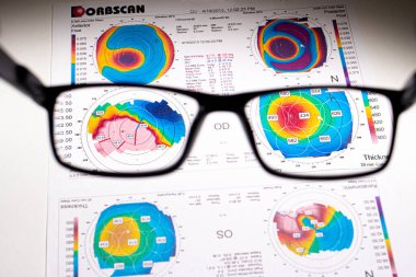 25.07.2020, Zarorizhzhya. Göz korneasının topografisi, tasarım. Keratoconus ve gözlük. Keratotopografi - göz muayenesi.