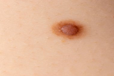 İnsan derisindeki köstebek doğum lekesi Nevus makro fotoğrafı. Kapat.